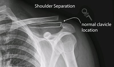 x-ray of a separated shoulder