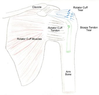 drawing of a torn rotator cuff