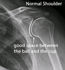 x-ray of a normal shoulder