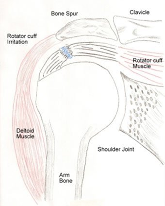 drawing of rotator cuff illustrartion