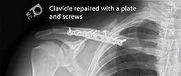 x-ray of a repaired clavicle