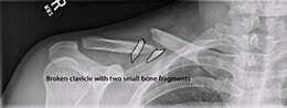 x-ray of a broken clavicle