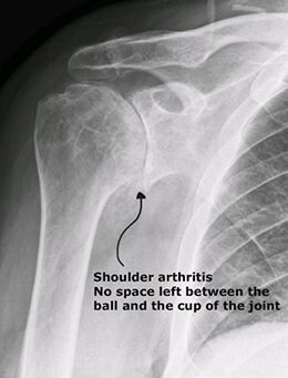 x-ray of a shoulder with a little cartilage in the joint