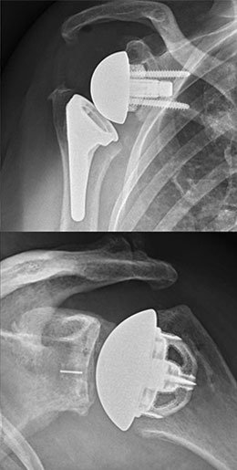 x-ray of a shoulder with replacement