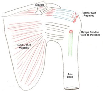 drawing of a repaired rotator cuff